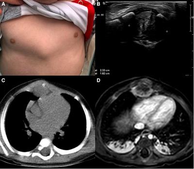 Case Report: Desmoid fibromatosis in the mediastinum of a 6-month-old toddler, what to do?